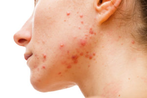 Treating Severe Acne