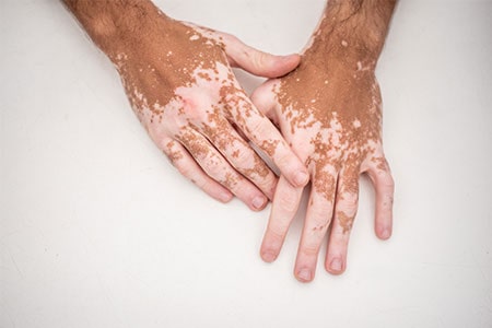 Pigmentation Disorders