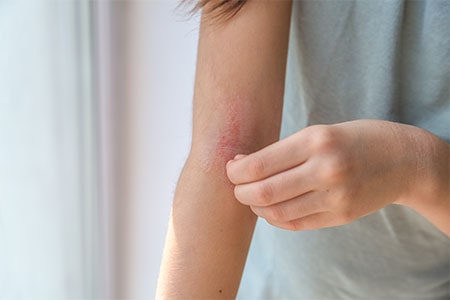 Eczema