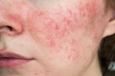 Rosacea
